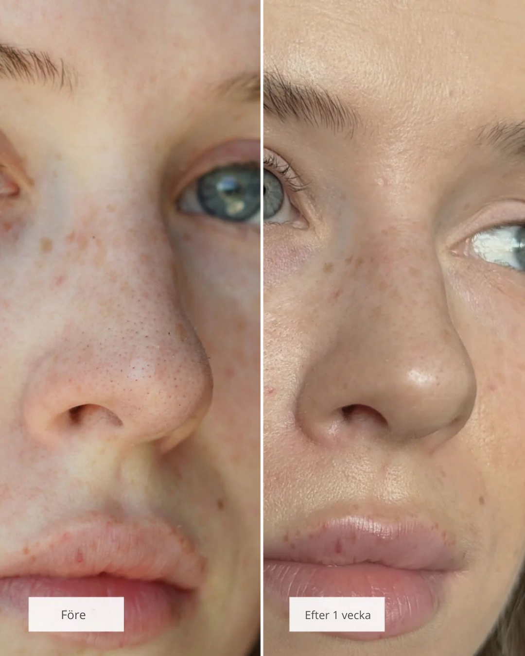 Nose Patches™ – Din väg till rena, fria porer