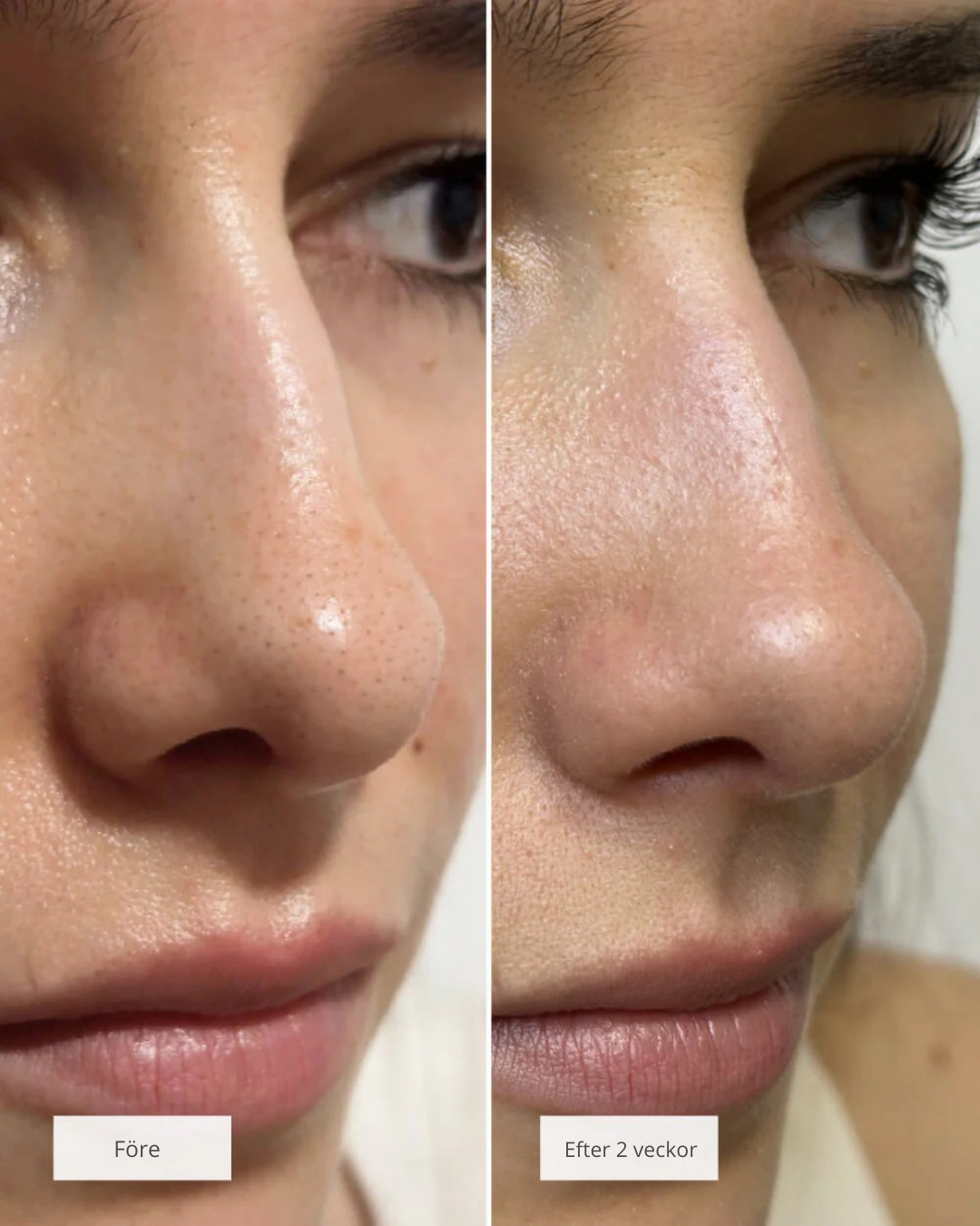 Nose Patches™ – Din väg till rena, fria porer