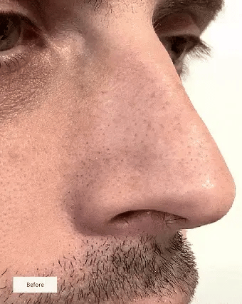 Nose Patches™ – Din väg till rena, fria porer